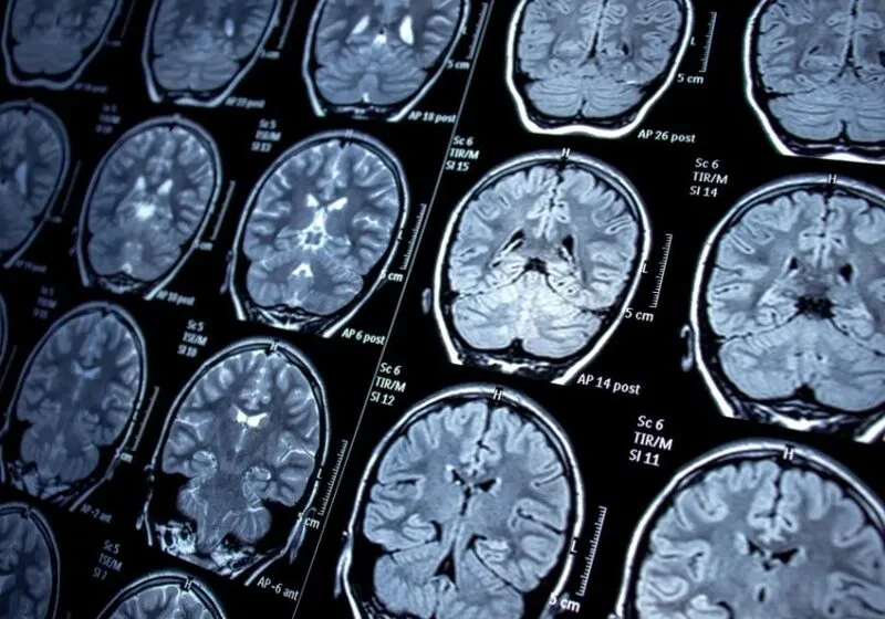 chẩn đoán punch drunk